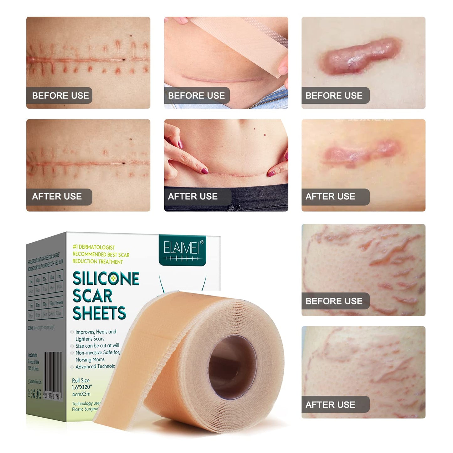 Silicone Scar Sheets (1.6” x 120” Roll-3M), Silicone Scar Tape Roll, Scar Silicone Strips, Reusable, Professional Scar Removal Sheets for C-Section, Surgery, Burn, Keloid, Acne et